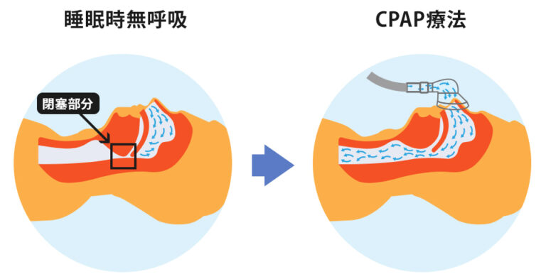 CPAP（シーパップ）療法