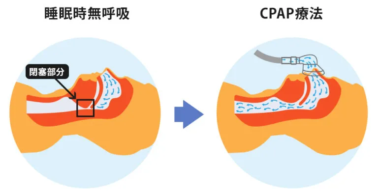CPAP(シーパップ)療法